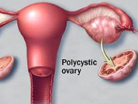 Rendelőben kérdezték: PCOS